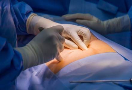 Comprehensive Care with a Hernia Surgeon in Dubai and General Surgeon in Dubai